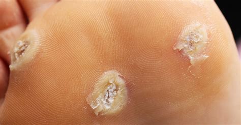 Young Plantar Warts