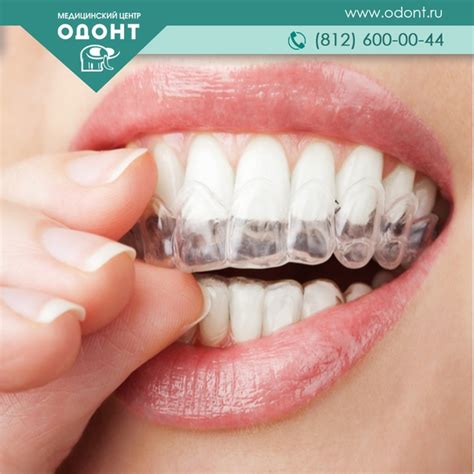 Отбеливание зубов с капами: Капы для отбеливания зубов в Москве, цены ...