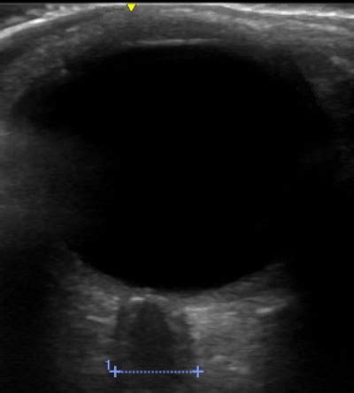 Ultrasound showing enlarged optic nerve sheath | Download Scientific ...