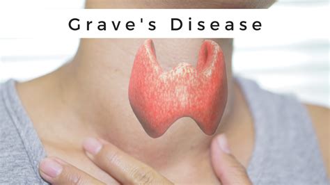 What Does A Graves Disease Thyroid Look Like On Ultrasound At Troy