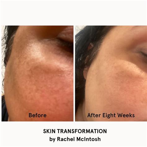 Skin Transformation With Obagi® Nuderm Skin And Sanctuary London