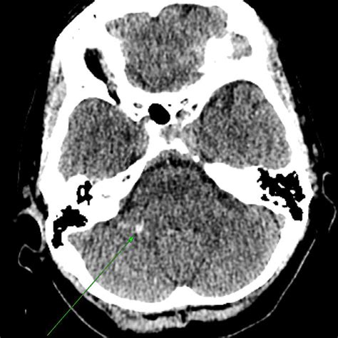 Axial Ct Angiogram The Dva Is Again Well Demonstrated A Connecting