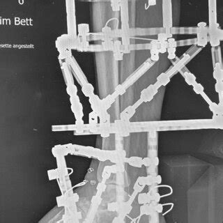 Anteroposterior x-ray view with attached TSF for simultaneous ...