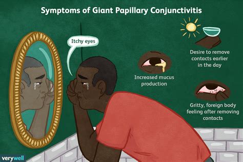 Giant Papillary Conjunctivitis Or Bumpy Eyelids