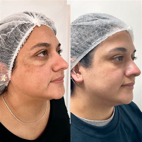 Tratamiento Laser Para La Melasma Amanda Beauty Spa