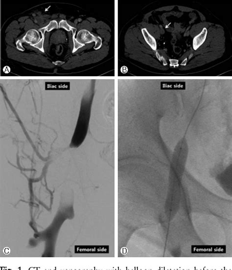 Figure 1 From Deep Vein Thrombosis Due To Hematoma As A Rare