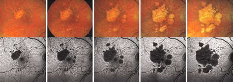 Syfovre Dry Macular Degeneration Treatment In Venice Fl