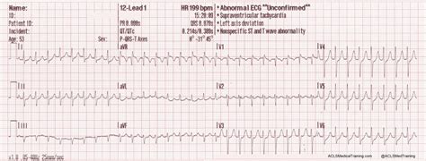 Treating Supraventricular Tachycardia with Adenosine