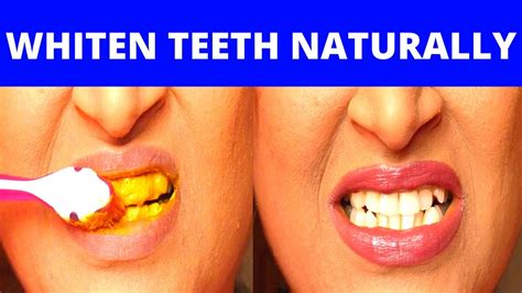 How To Whiten Your Teeth With Coconut Oil And Turmeric How To Whiten