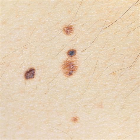 liver spots on face 8