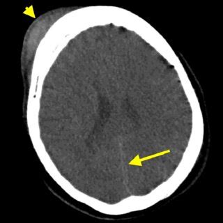 ct head  contrast  admission  scientific diagram