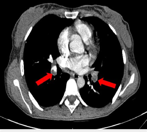 Thorax Ct Showing Bilateral Pulmonary Artery Thrombus With Filling Download Scientific Diagram