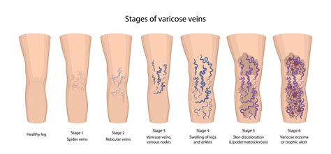 Chronic Venous Insufficiency - El Paso, TX: Imaging & Interventional