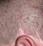 10 Home Remedies for Scalp Folliculitis - Home Remedies - Natural ...