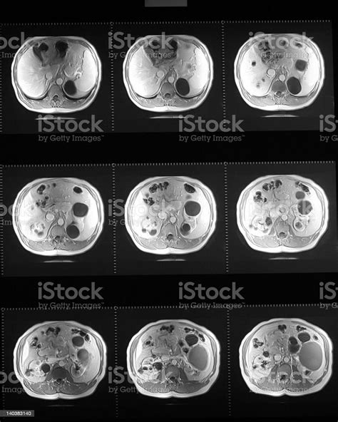 Mri Of The Kidneys Showing Polycystic Lesions Stock Photo Download