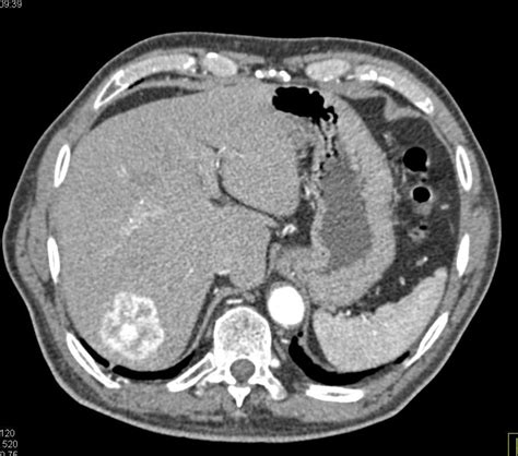 Hepatic Hemangioma Liver Case Studies Ctisus Ct Scanning