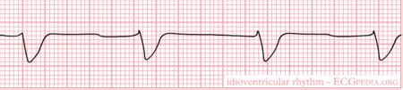 idioventricular rhythm ecgpedia
