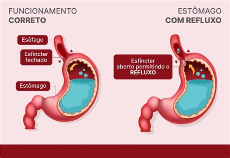 Refluxo Gastroesofágico Tem Cura - Refluxo Saiba Como Tratar E Prevenir