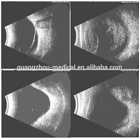 Ophthalmic Ultrasound Devices - Eye Imaging