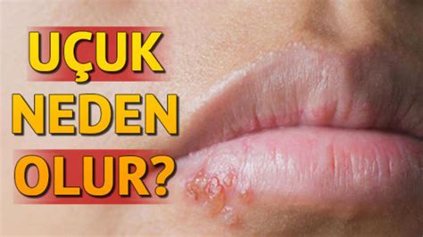 Herpes virüsü nedir