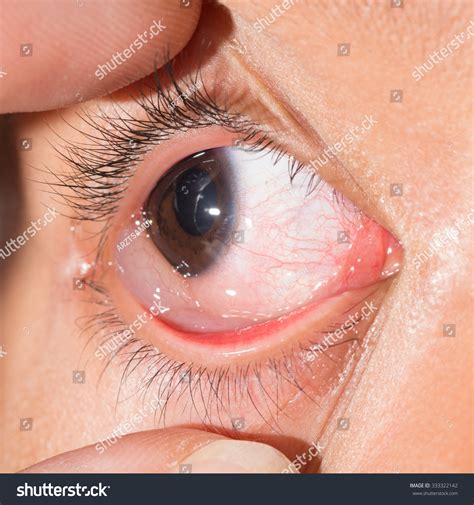 Close Up Of Chemosis Injected Allergic Eye During Eye Examination