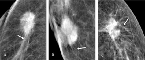spiculated masses  histopathological grade   grade ii