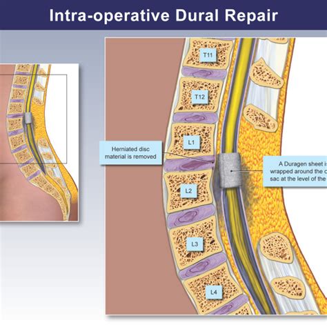 Medical Legal Exhibits Legal Animations Trial Graphics Tria