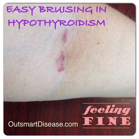 Why easy bruising is so common in hypothyroidism? Many hypothyroid and ...