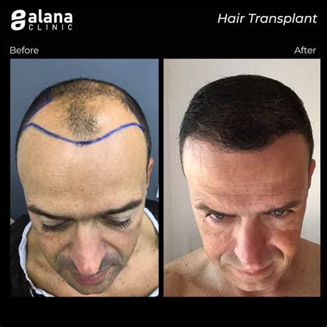 Injerto Capilar Fue En Turqu A Alana Hair Clinic