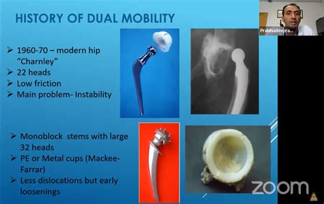 Dual Mobility Components In Total Hip Arthroplasty