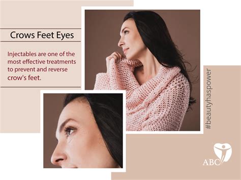 Botox For Crows Feet Eyes The Advanced Aesthetic Injection Treatment