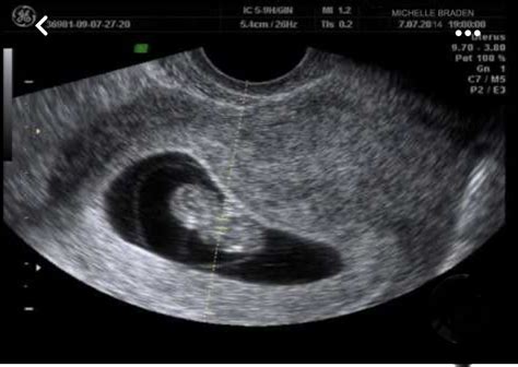Fetal Pictures Of Ultrasounds Gallery Artofit
