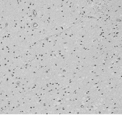 Photomicrograph Of The Tumor Showing Mature Neural Tissue With No