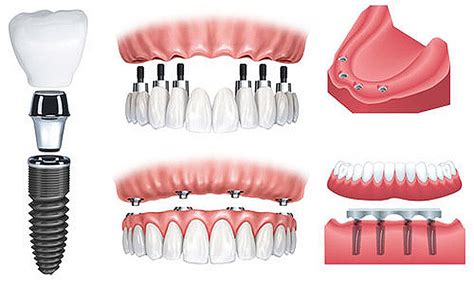 Quy trình thực hiện phương pháp cấy ghép Implant lâu bền nhất