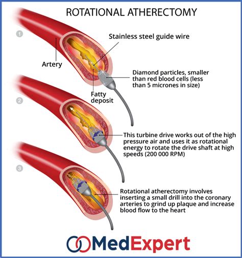 Critical Limb Ischaemia Treatment Diagnosis And Cli Symptoms Med Expert