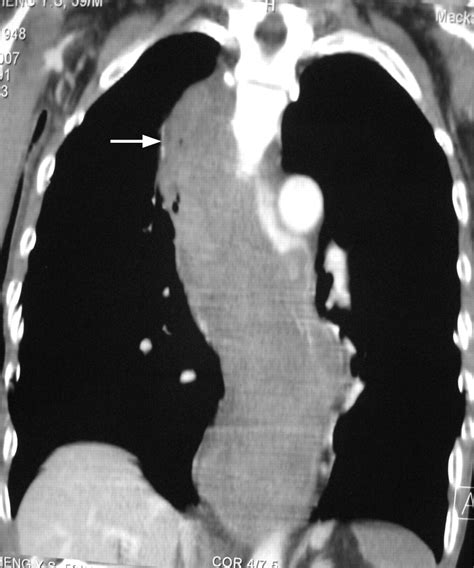 Acute Widening Of Mediastinum In A Patient With Oesophageal Cancer After Surgery Bmj Case Reports