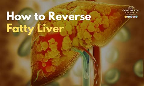 reverse fatty liver
