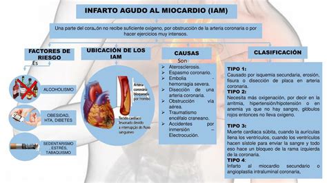 Infarto Agudo Al Miocardio Resumen Infarto Agudo Al Miocardio Con Y My Xxx Hot Girl