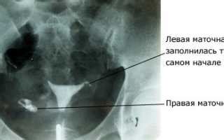 Проведение процедуры гистеросальпингографии