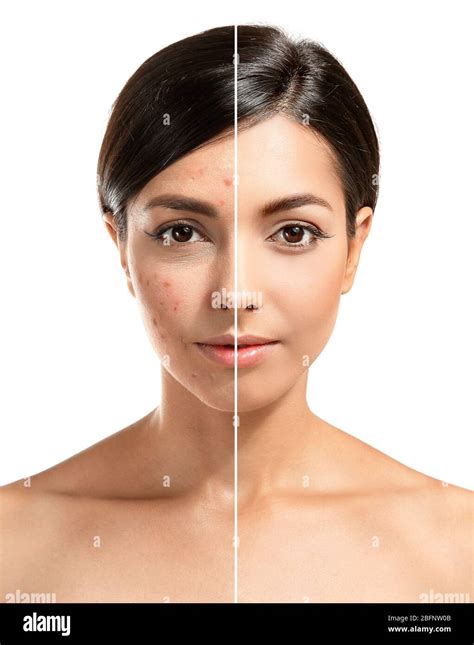 Woman Face Before And After Acne Treatment Procedure Skin Care Concept