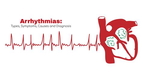 Arrhythmias Types Symptom Cause Treatment Stat Cardiologist