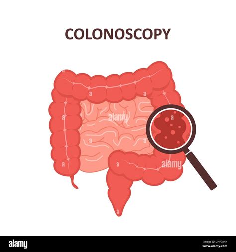 Colonoscopy Concept Intestine Exam And Treatment Colon Polypectomy