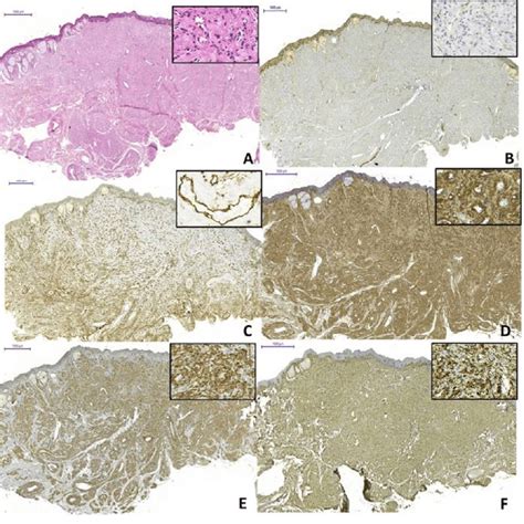 Morphological And Immunohistochemical Features Of Angioleiomyoma A