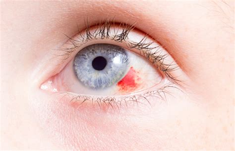 Eye Emergencies Dhruveyecare