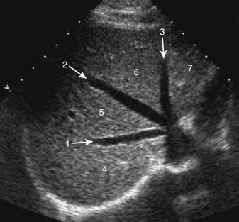 Liver Ultrasound Anatomy