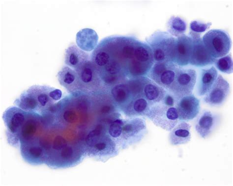 Pathology Outlines Apocrine Adenosis Atypical Apocrine Adenosis