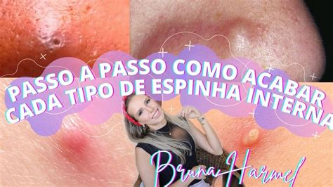 O'que Fazer Com Espinha Interna - PASSO A PASSO PARA TIRAR ESPINHAS INTERNAS DE TODOS OS TIPOS - Bruna ...
