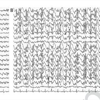 ctal EEG in Patient 1. A) Seizure onset: irregular rhythmic 1-2 Hz... | Download Scientific Diagram