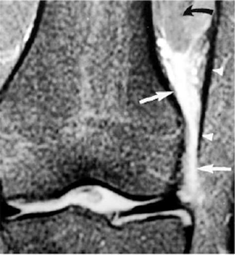Iliotibial Band Syndrome Understanding Biomechanics C