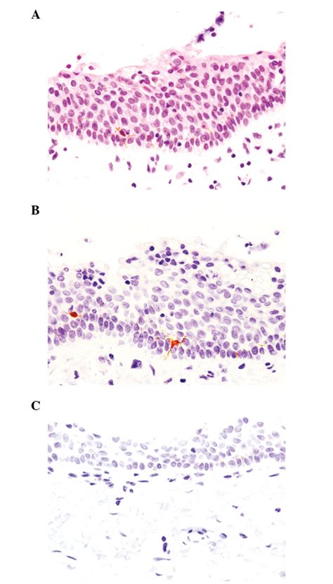 Histopathological And Immunohistochemical Features Of The Nodule On The Download Scientific